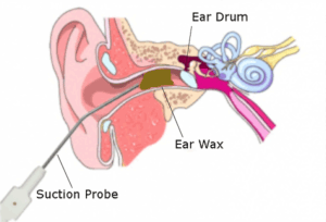 Micro-Suction Ear Wax Removal